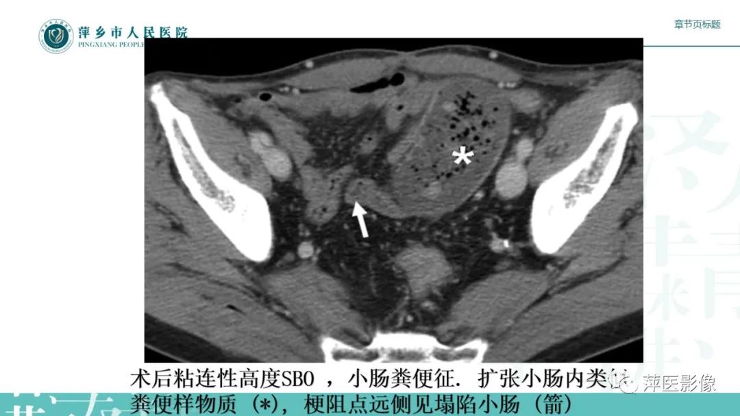 【PPT】肠梗阻读片之小肠篇-27