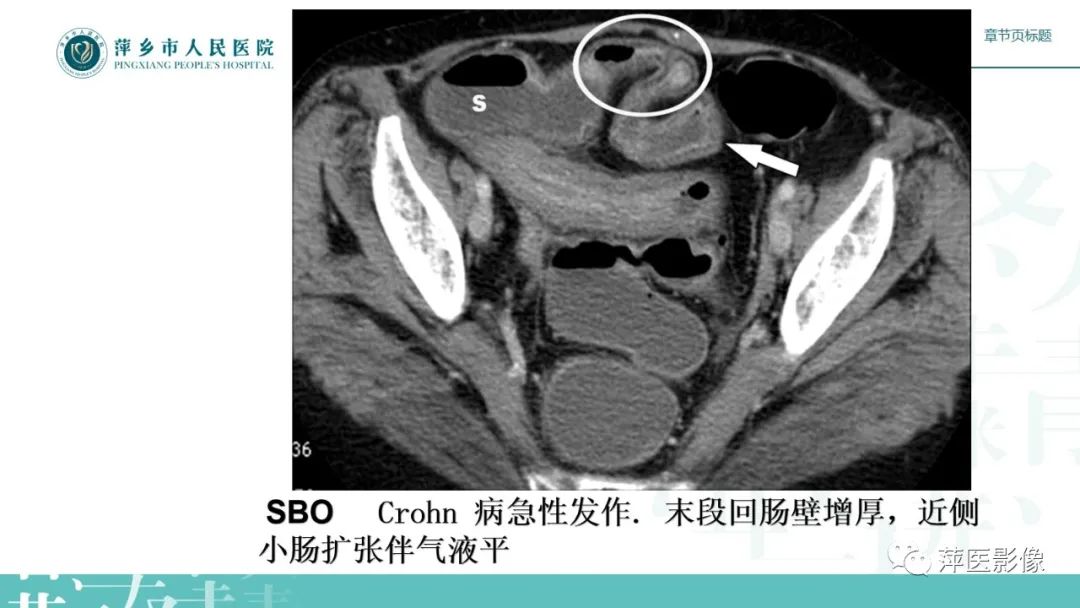 【PPT】肠梗阻读片之小肠篇-30