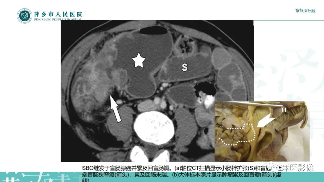 【PPT】肠梗阻读片之小肠篇-31