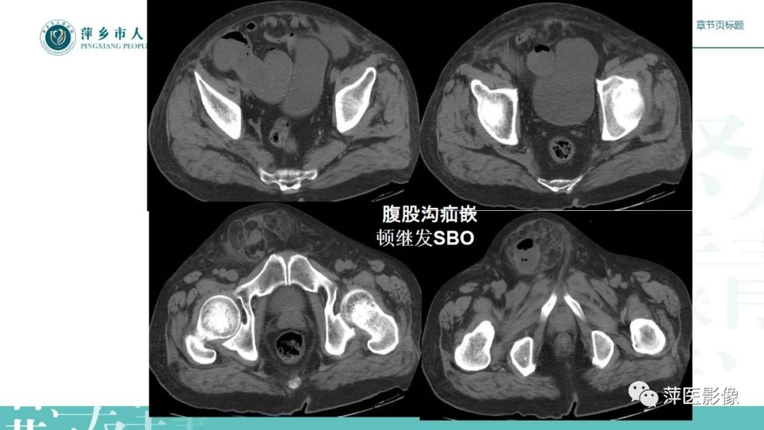 【PPT】肠梗阻读片之小肠篇-32