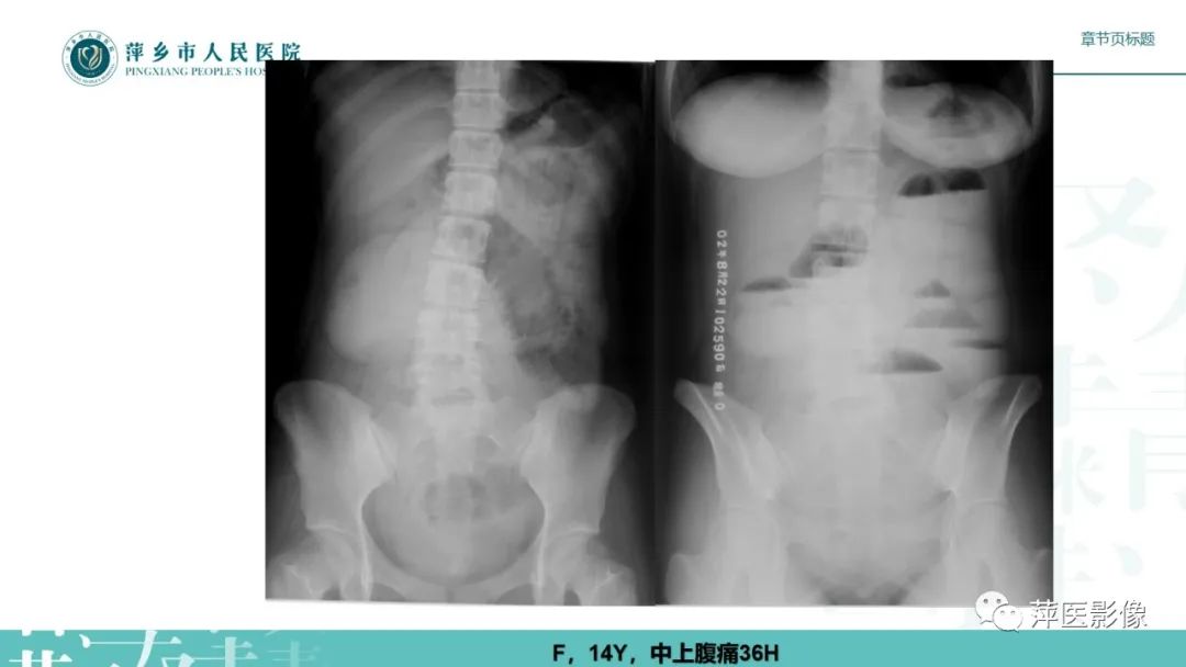 【PPT】肠梗阻读片之小肠篇-33