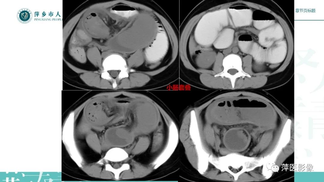 【PPT】肠梗阻读片之小肠篇-34