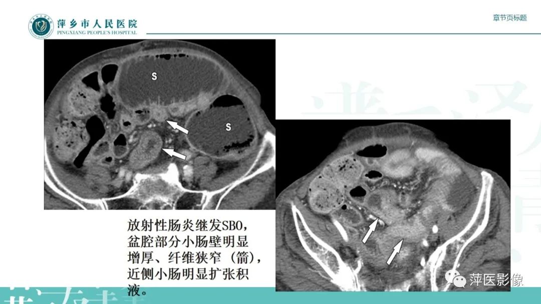 【PPT】肠梗阻读片之小肠篇-35