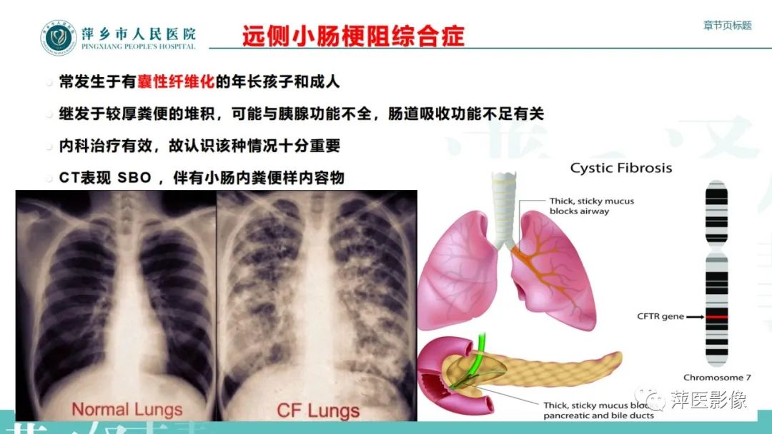 【PPT】肠梗阻读片之小肠篇-36