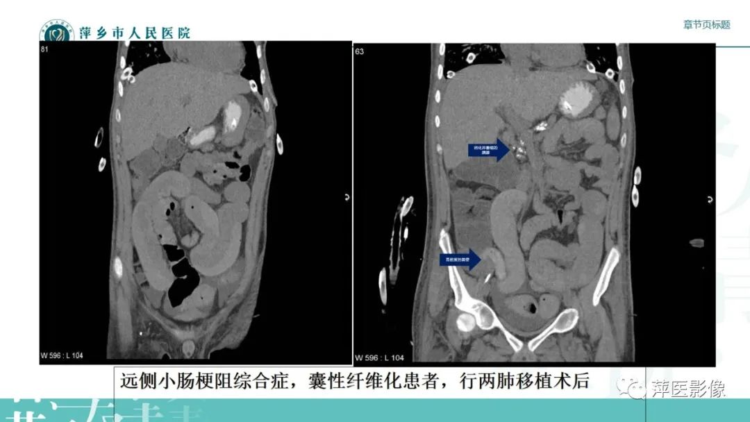 【PPT】肠梗阻读片之小肠篇-37