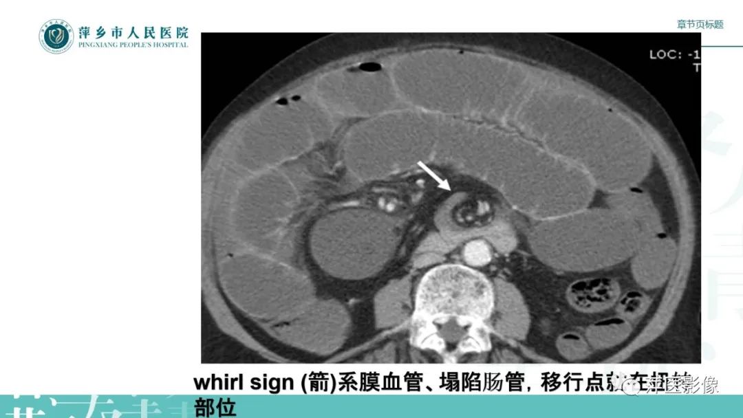 【PPT】肠梗阻读片之小肠篇-43