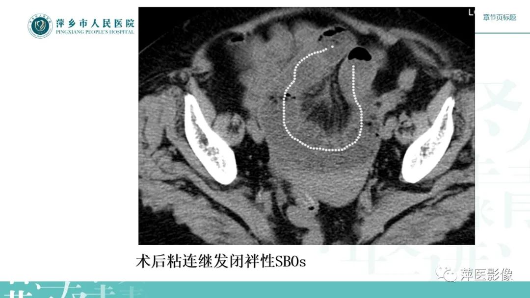 【PPT】肠梗阻读片之小肠篇-41