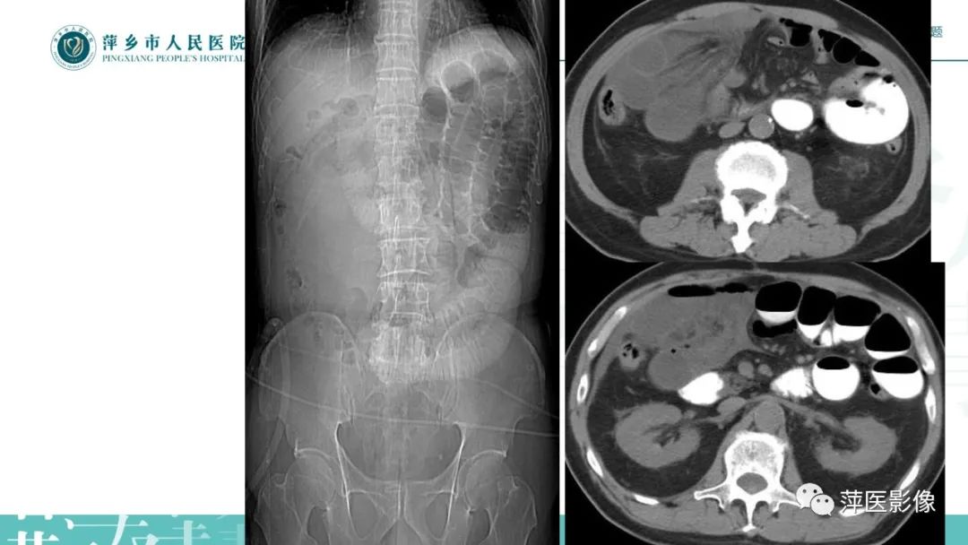 【PPT】肠梗阻读片之小肠篇-45