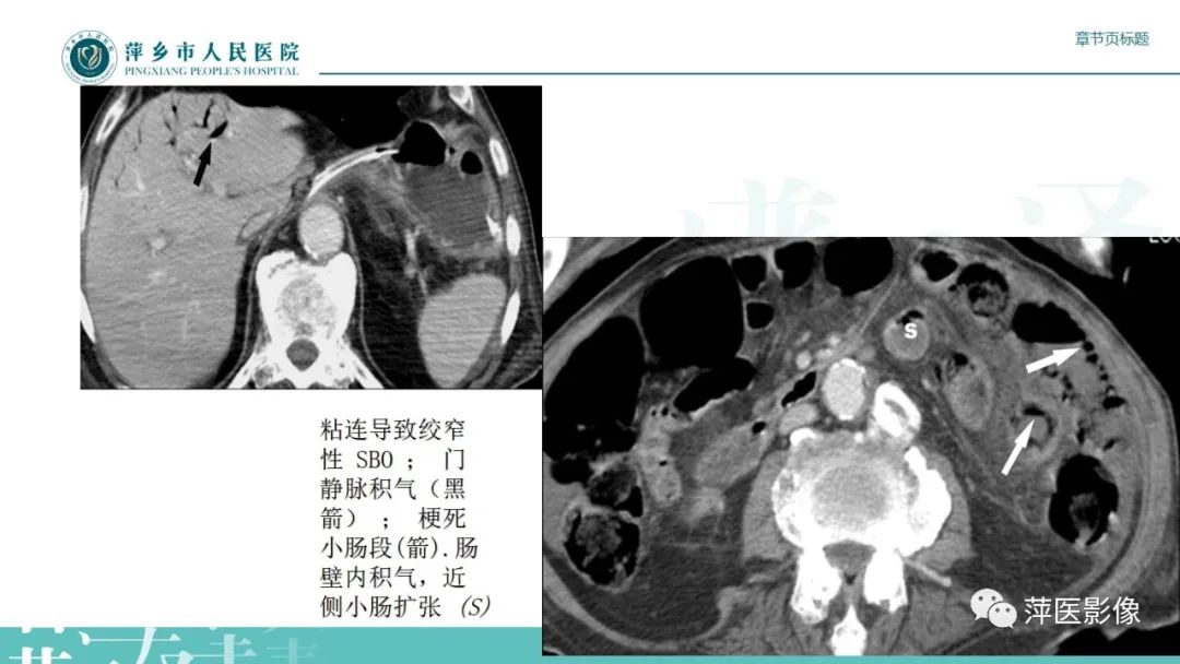 【PPT】肠梗阻读片之小肠篇-46