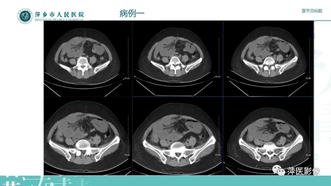 【PPT】肠梗阻读片之小肠篇-51