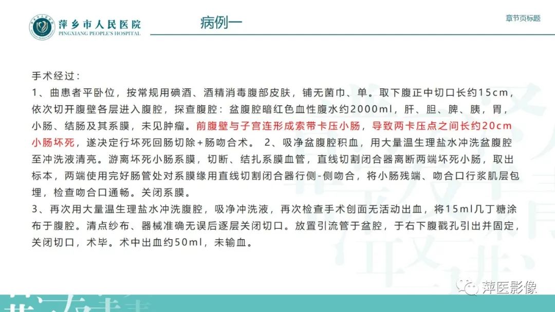 【PPT】肠梗阻读片之小肠篇-52