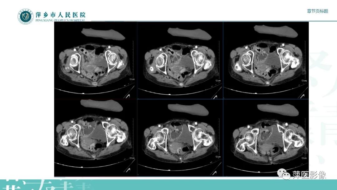 【PPT】肠梗阻读片之小肠篇-54