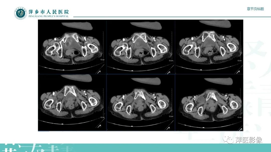 【PPT】肠梗阻读片之小肠篇-55