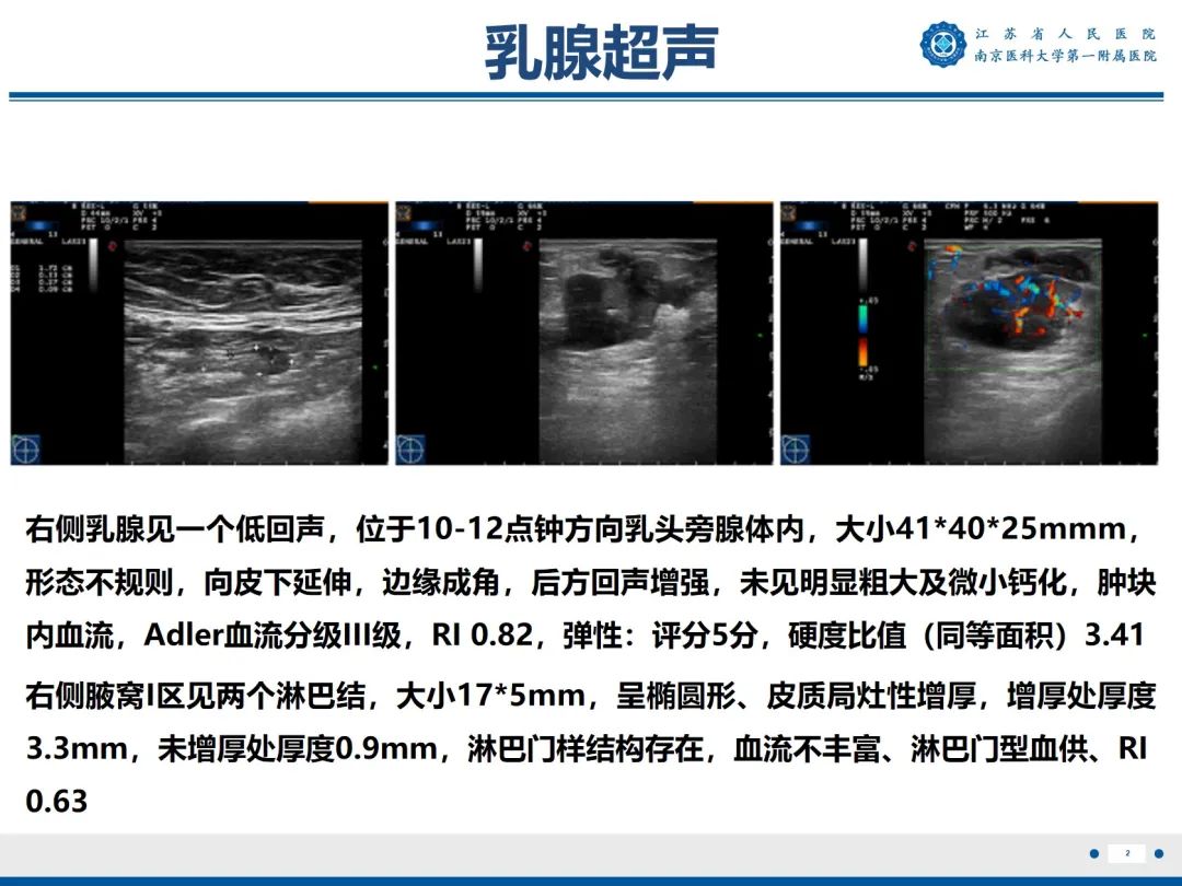 【PPT】浸润性乳腺癌，非特殊类型-3
