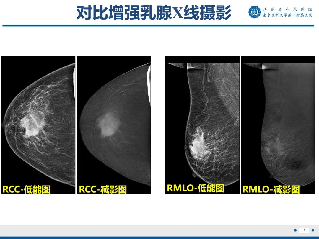 【PPT】浸润性乳腺癌，非特殊类型-4