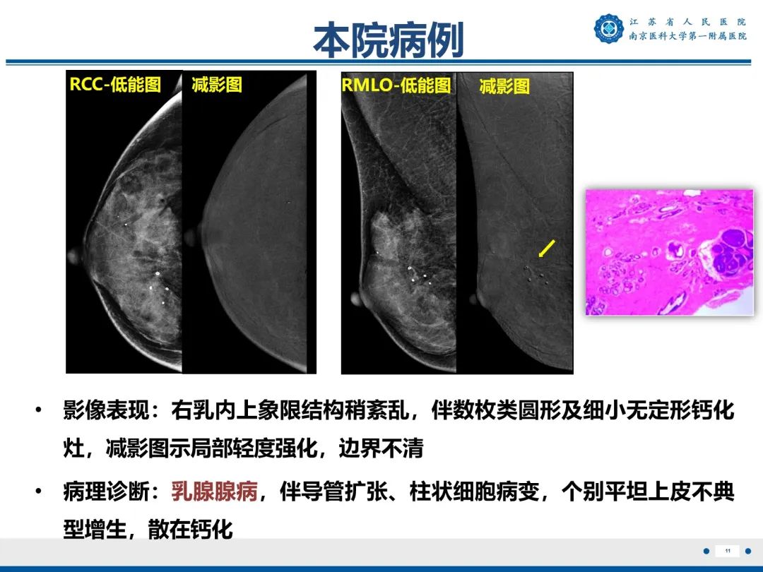 【PPT】浸润性乳腺癌，非特殊类型-12