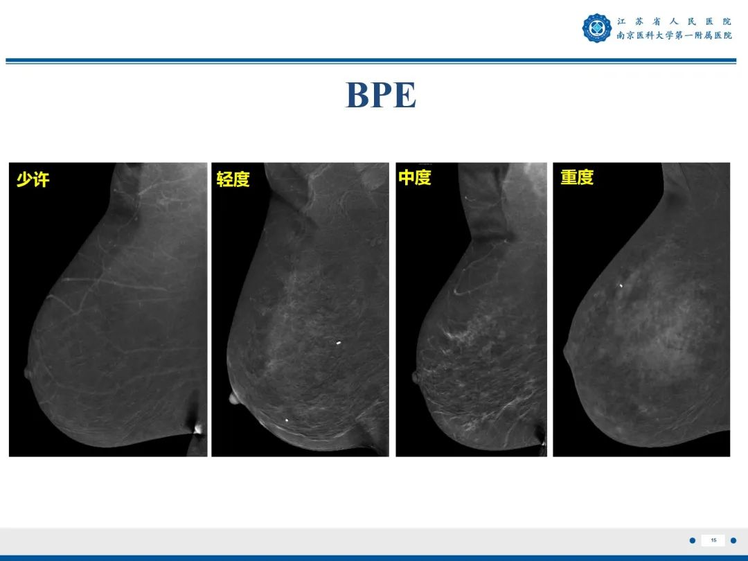 【PPT】浸润性乳腺癌，非特殊类型-16