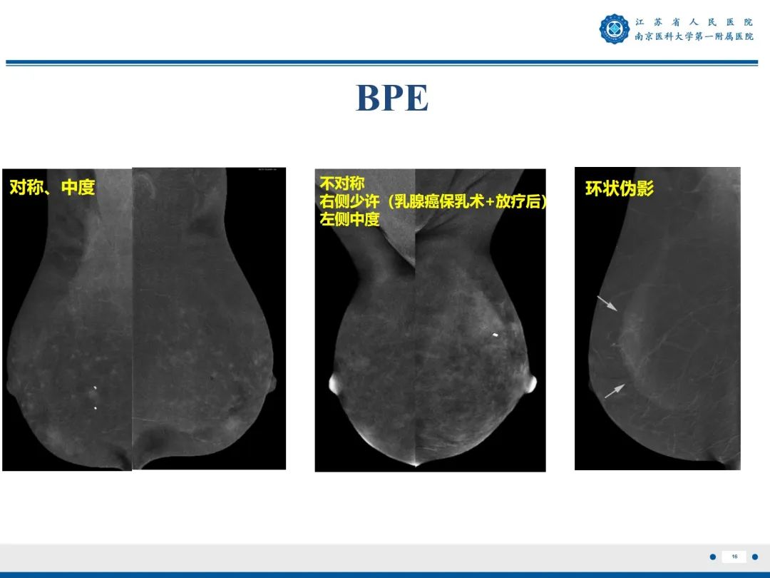 【PPT】浸润性乳腺癌，非特殊类型-17