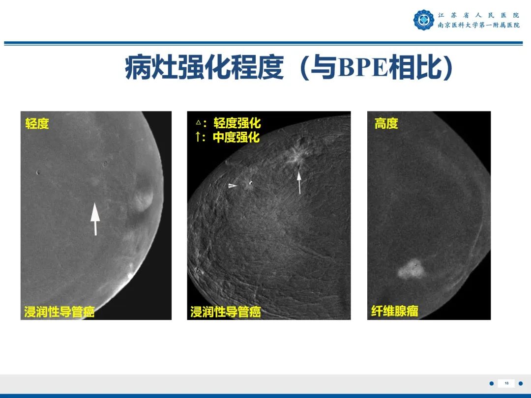 【PPT】浸润性乳腺癌，非特殊类型-19