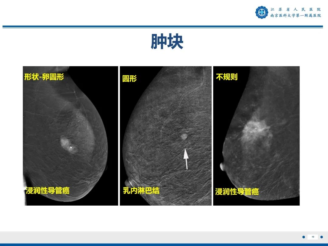 【PPT】浸润性乳腺癌，非特殊类型-20