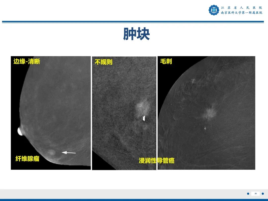 【PPT】浸润性乳腺癌，非特殊类型-21