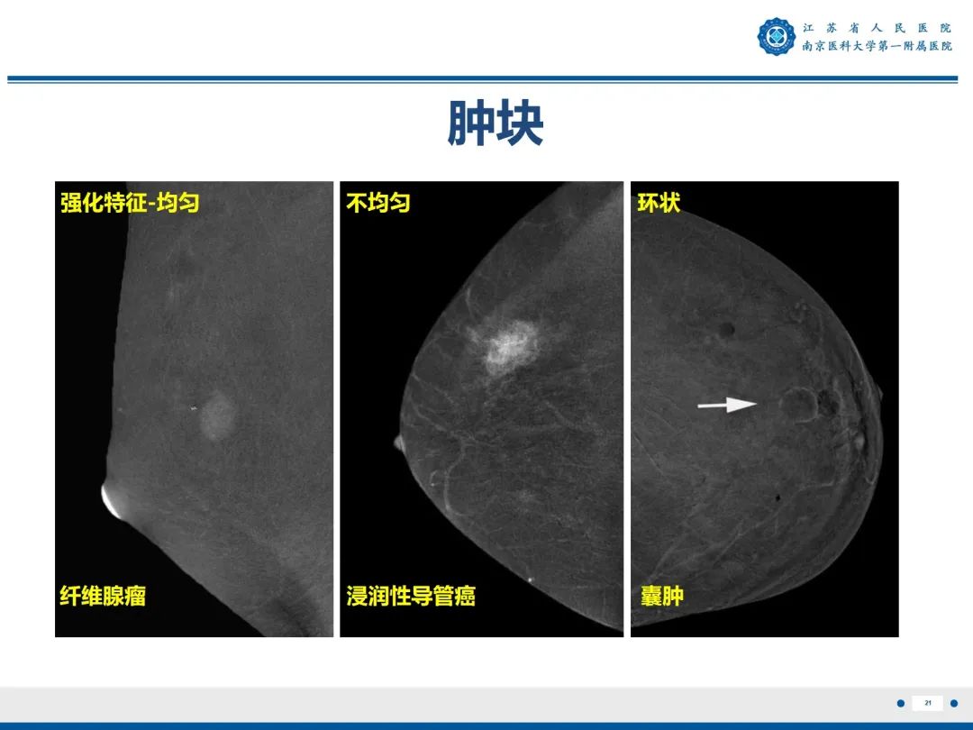 【PPT】浸润性乳腺癌，非特殊类型-22