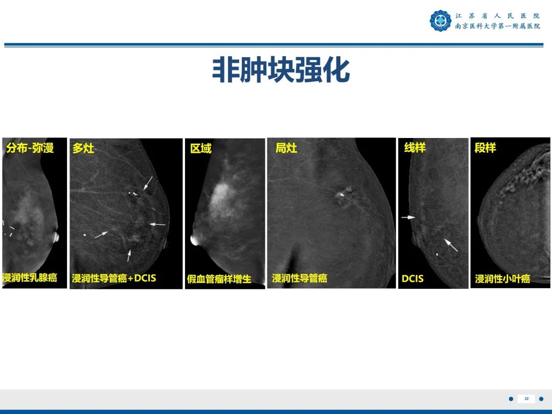 【PPT】浸润性乳腺癌，非特殊类型-23