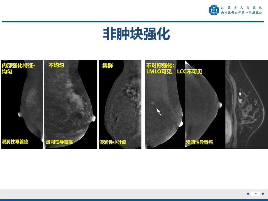 【PPT】浸润性乳腺癌，非特殊类型-24