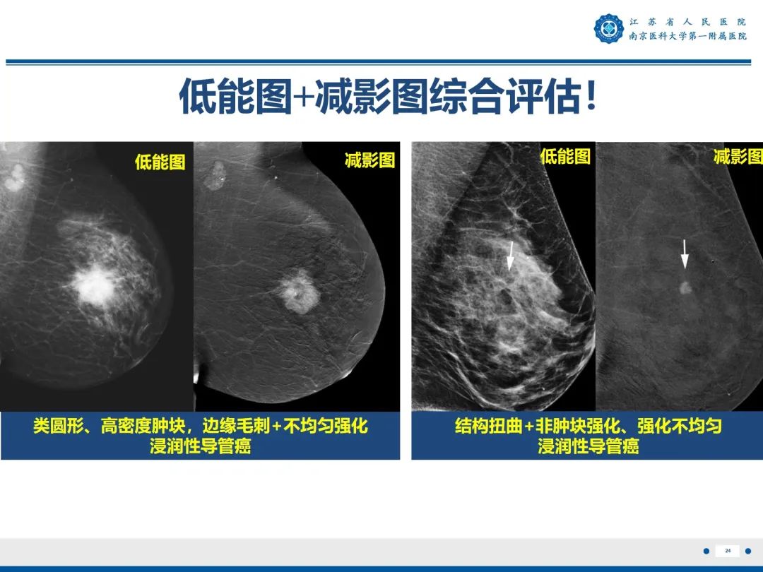 【PPT】浸润性乳腺癌，非特殊类型-25