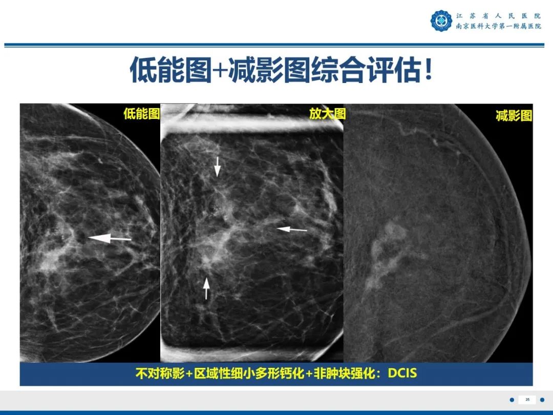 【PPT】浸润性乳腺癌，非特殊类型-26