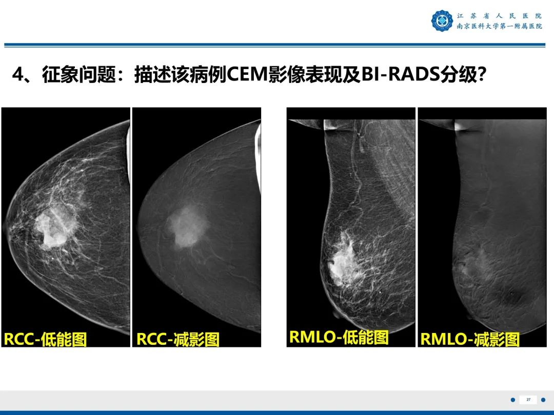 【PPT】浸润性乳腺癌，非特殊类型-28