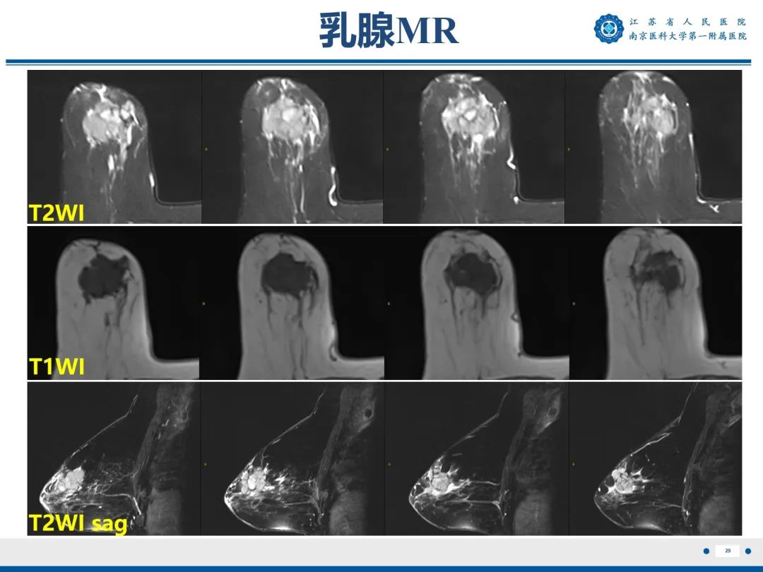 【PPT】浸润性乳腺癌，非特殊类型-30