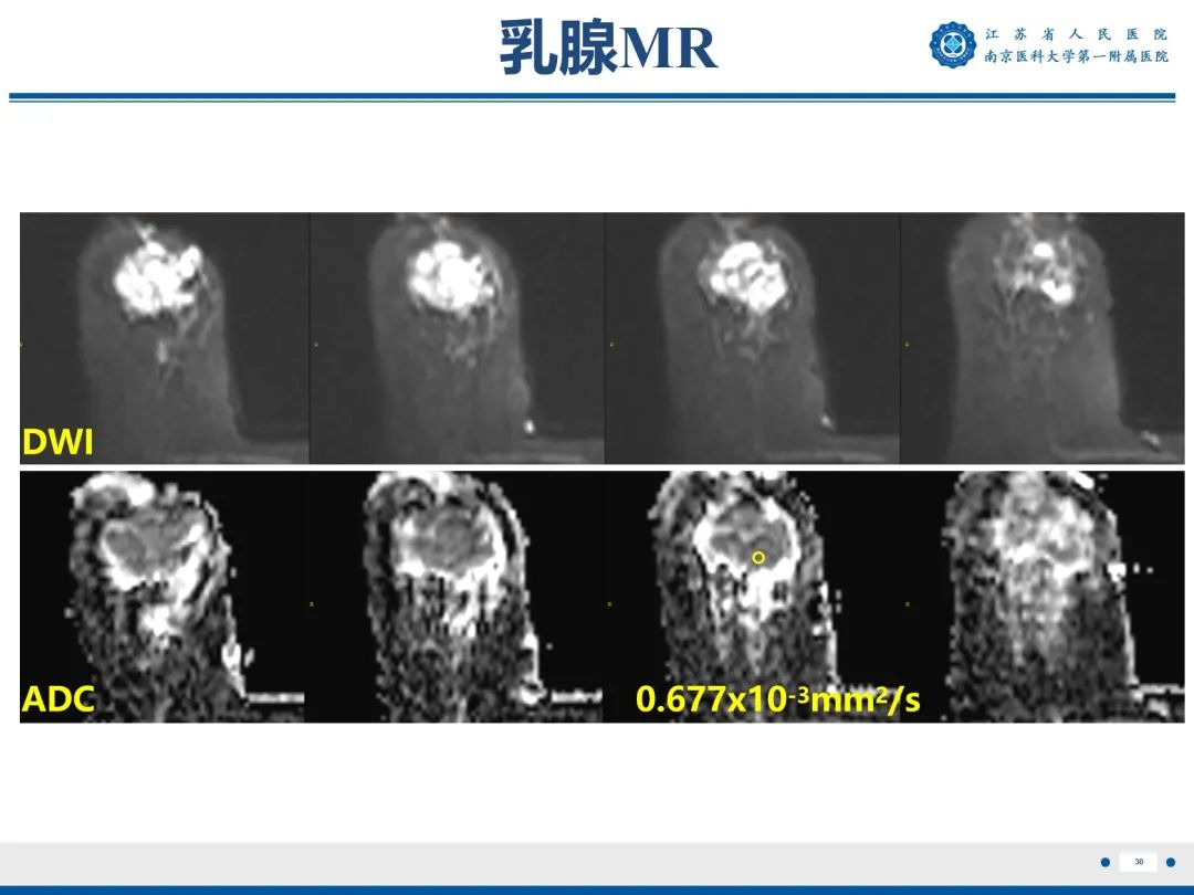 【PPT】浸润性乳腺癌，非特殊类型-31
