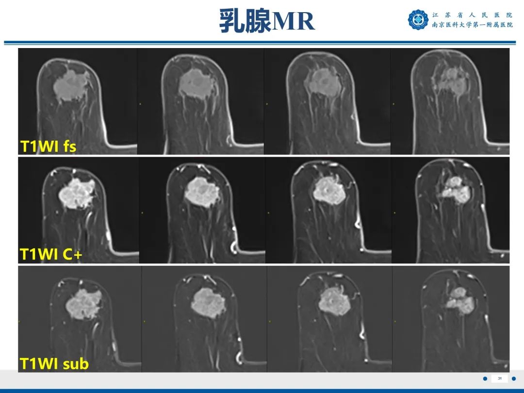 【PPT】浸润性乳腺癌，非特殊类型-32