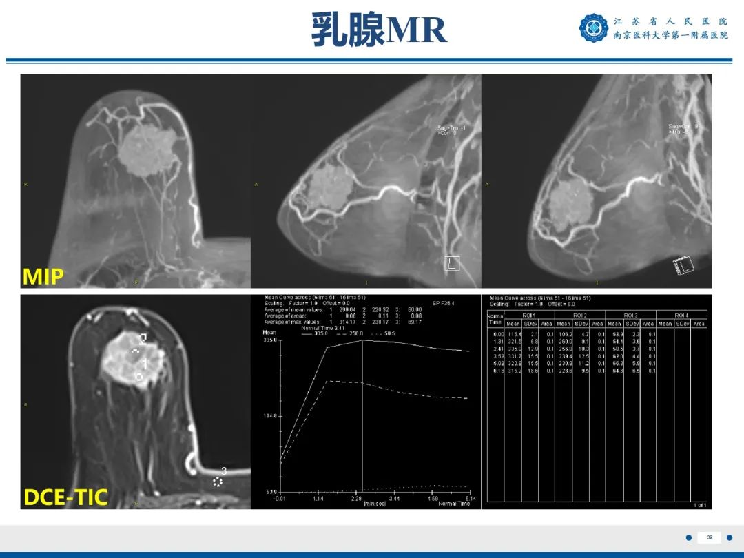 【PPT】浸润性乳腺癌，非特殊类型-33