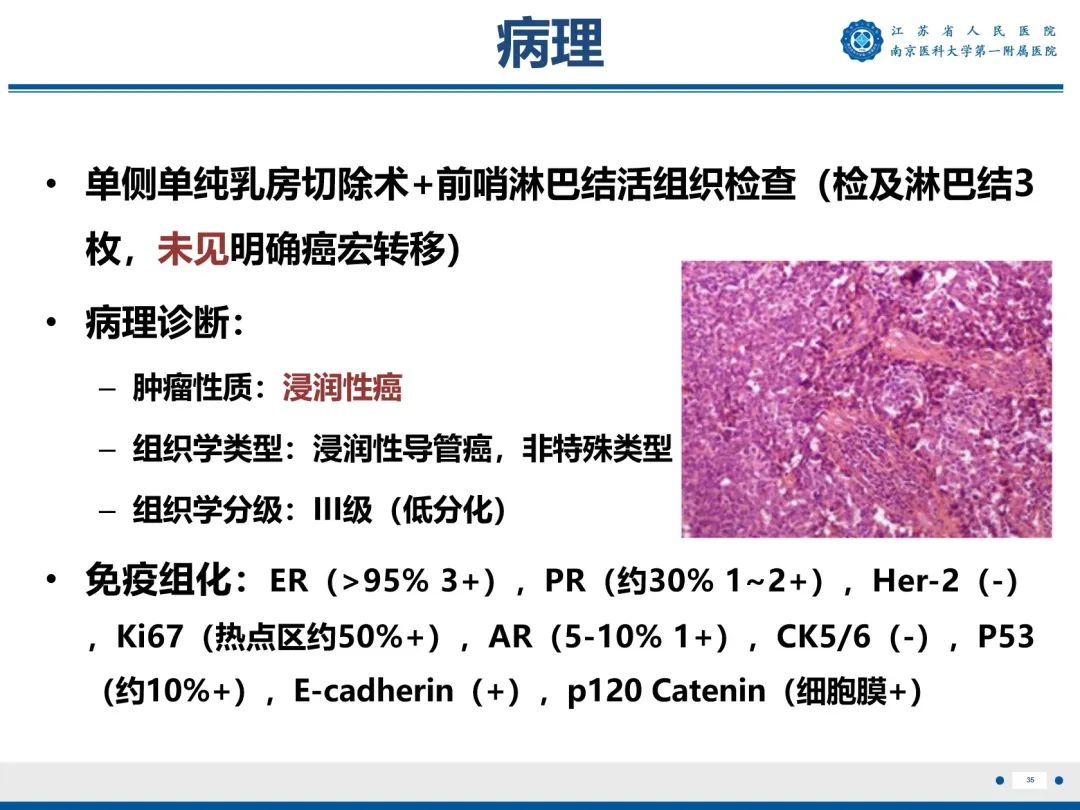 【PPT】浸润性乳腺癌，非特殊类型-36