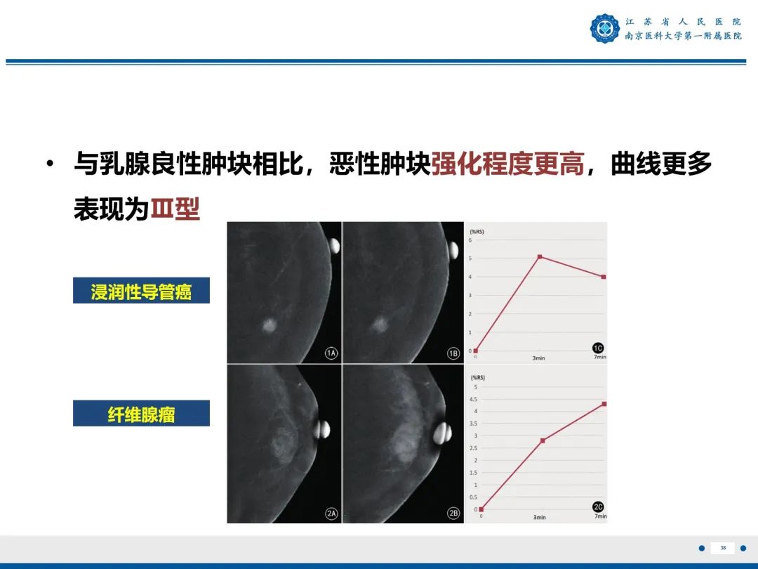 【PPT】浸润性乳腺癌，非特殊类型-39