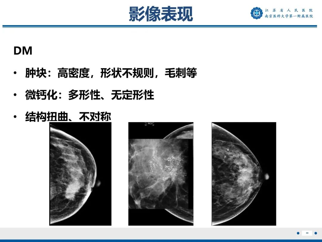 【PPT】浸润性乳腺癌，非特殊类型-45