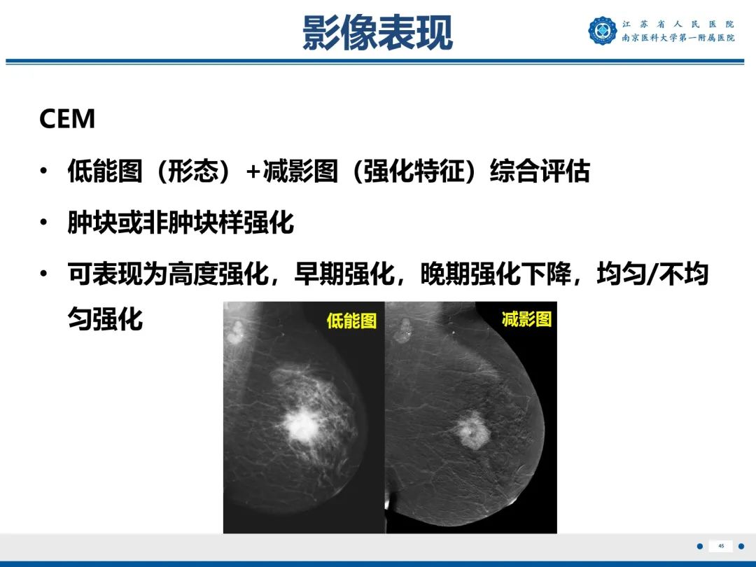 【PPT】浸润性乳腺癌，非特殊类型-46