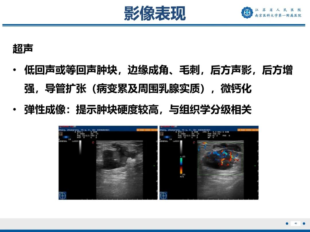 【PPT】浸润性乳腺癌，非特殊类型-47