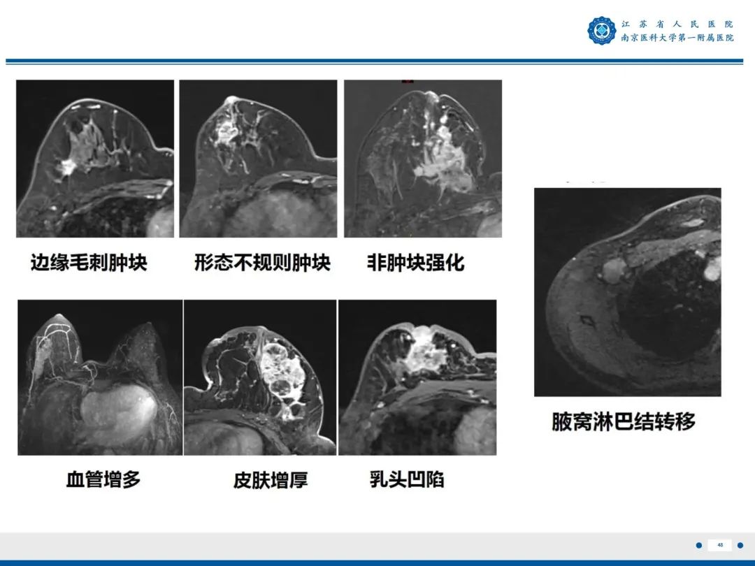 【PPT】浸润性乳腺癌，非特殊类型-49