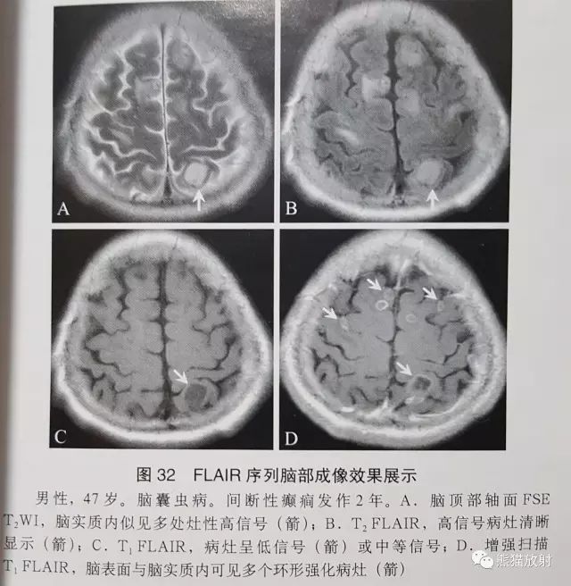 液体衰减反转恢复(FLAIR)序列图像有何特点-3