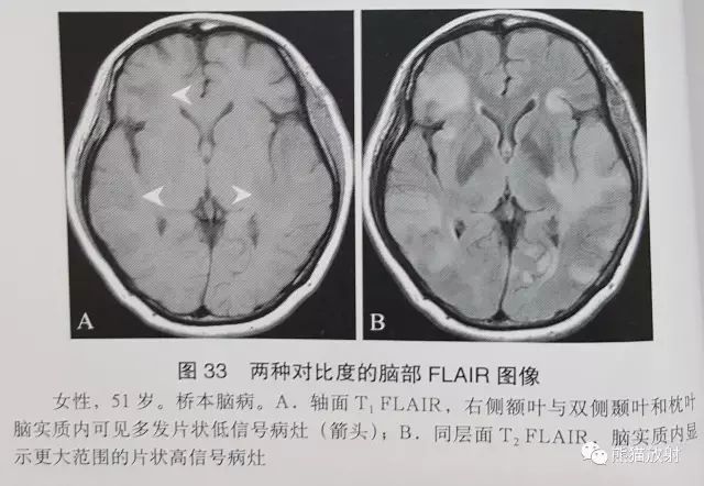 液体衰减反转恢复(FLAIR)序列图像有何特点-4