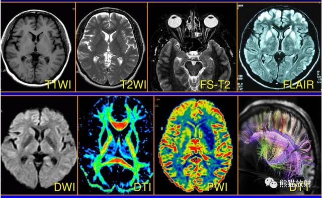 液体衰减反转恢复(FLAIR)序列图像有何特点-10