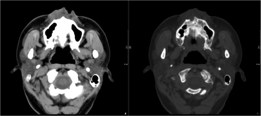 颌面部间隙感染影像诊断及各间隙解剖-7