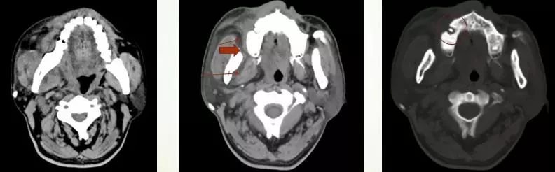 颌面部间隙感染影像诊断及各间隙解剖-8