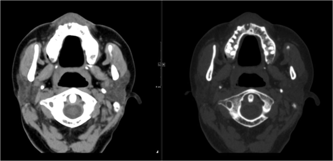颌面部间隙感染影像诊断及各间隙解剖-6