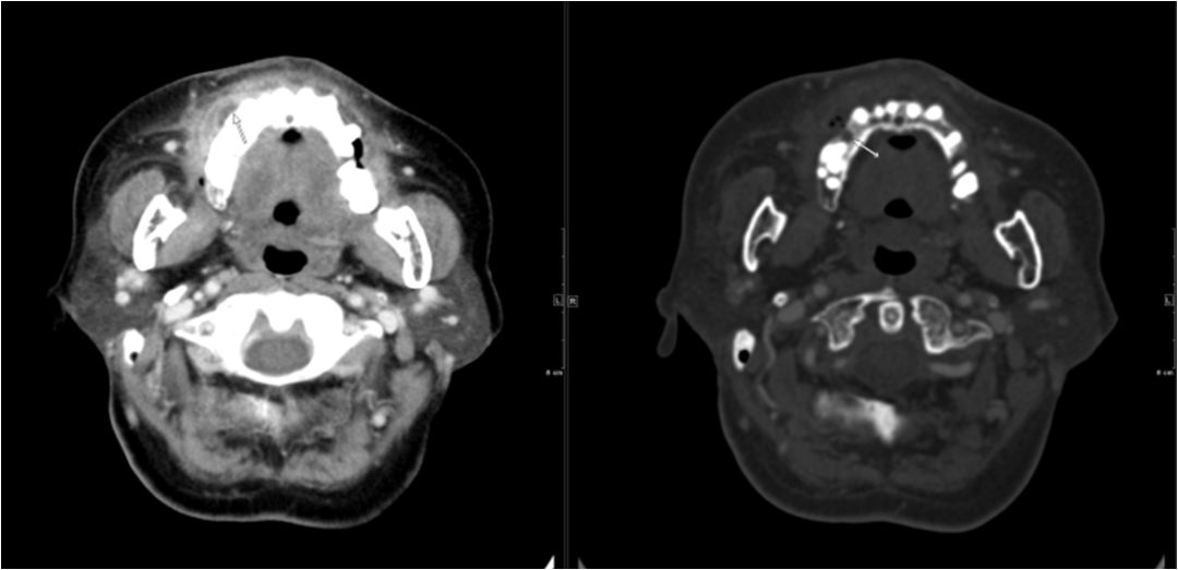 颌面部间隙感染影像诊断及各间隙解剖-9