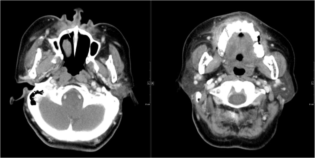 颌面部间隙感染影像诊断及各间隙解剖-10