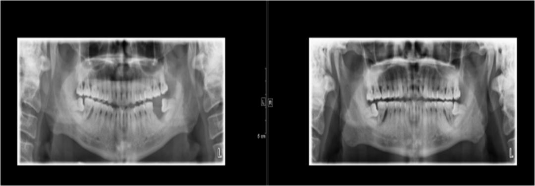 颌面部间隙感染影像诊断及各间隙解剖-11
